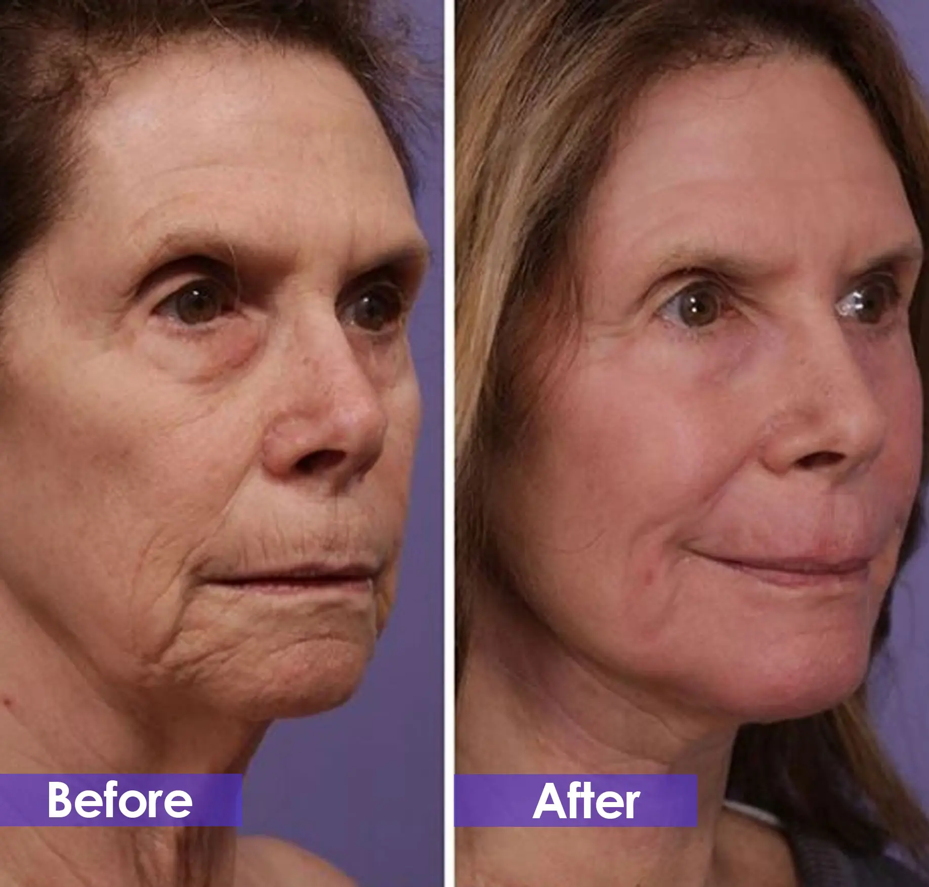 What is the best skin rejuvenation treatment